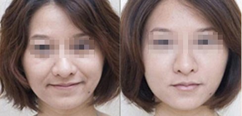 新疆法令纹如何消除