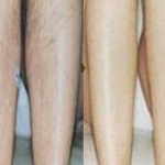 乌鲁木齐大小腿脱毛多少钱