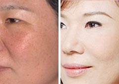 新疆乌鲁木齐黄褐斑可以去除吗