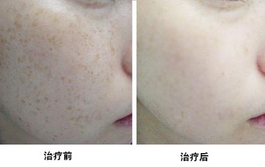 激光祛黄褐斑速度快效果好